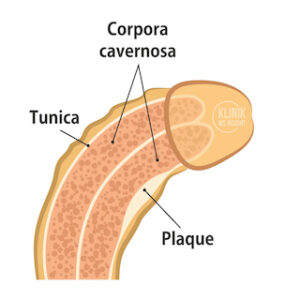 Plaque in penis curvature medical treatment